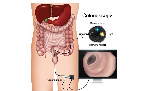 UNG THƯ ĐẠI TRÀNG NGUYÊN NHÂN, DIỄN TIẾN BỆNH VÀ CÁCH PHÒNG NGỪA HIỆU QUẢ